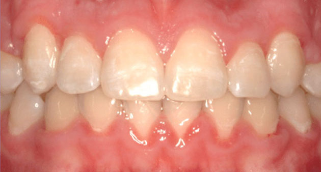 After treatment 1