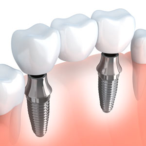 Dental Implants