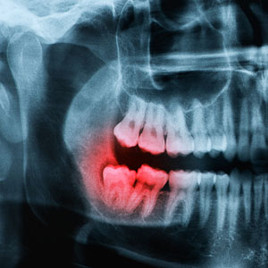 Removal of Wisdom Teeth